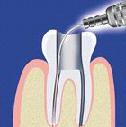 Oeten koenovch kanlk laserem (endodoncie)